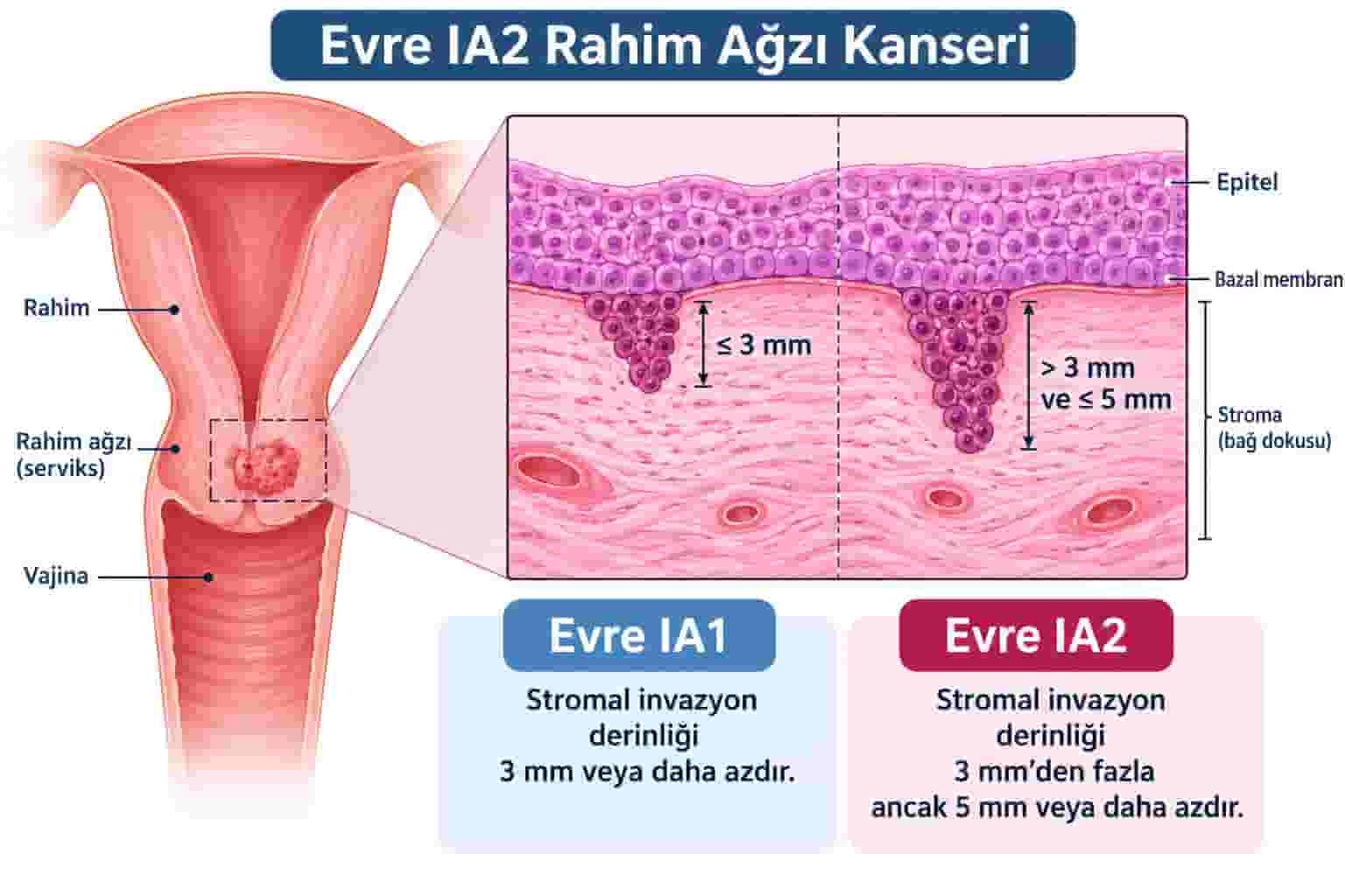 Evre IA2 Rahim Ağzı Kanseri Tedavisi