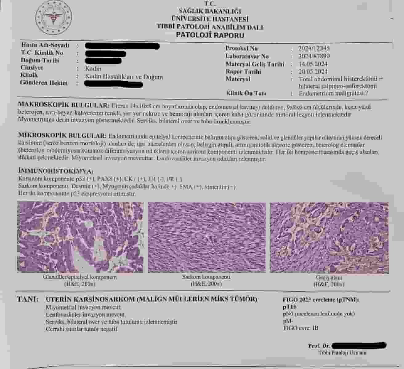 Uterin Karsinosarkom Nedir? Belirtileri, Ameliyatı ve Tedavisi
