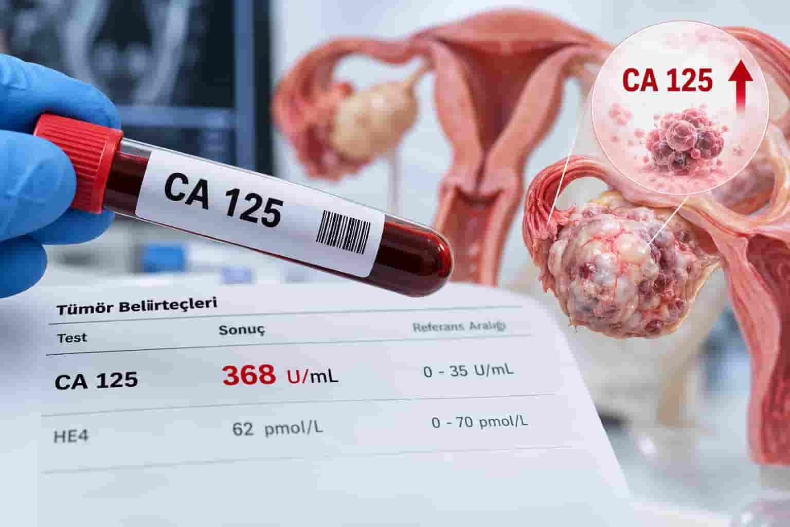 CA-125 Yüksekliği Nedir? Yumurtalık Kanseri Anlamına mı Gelir?
